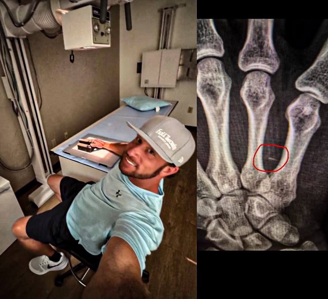 A FISH FIN, NERVE DAMAGE AND ZERO MISSED EVENTS FOR SHRYOCK